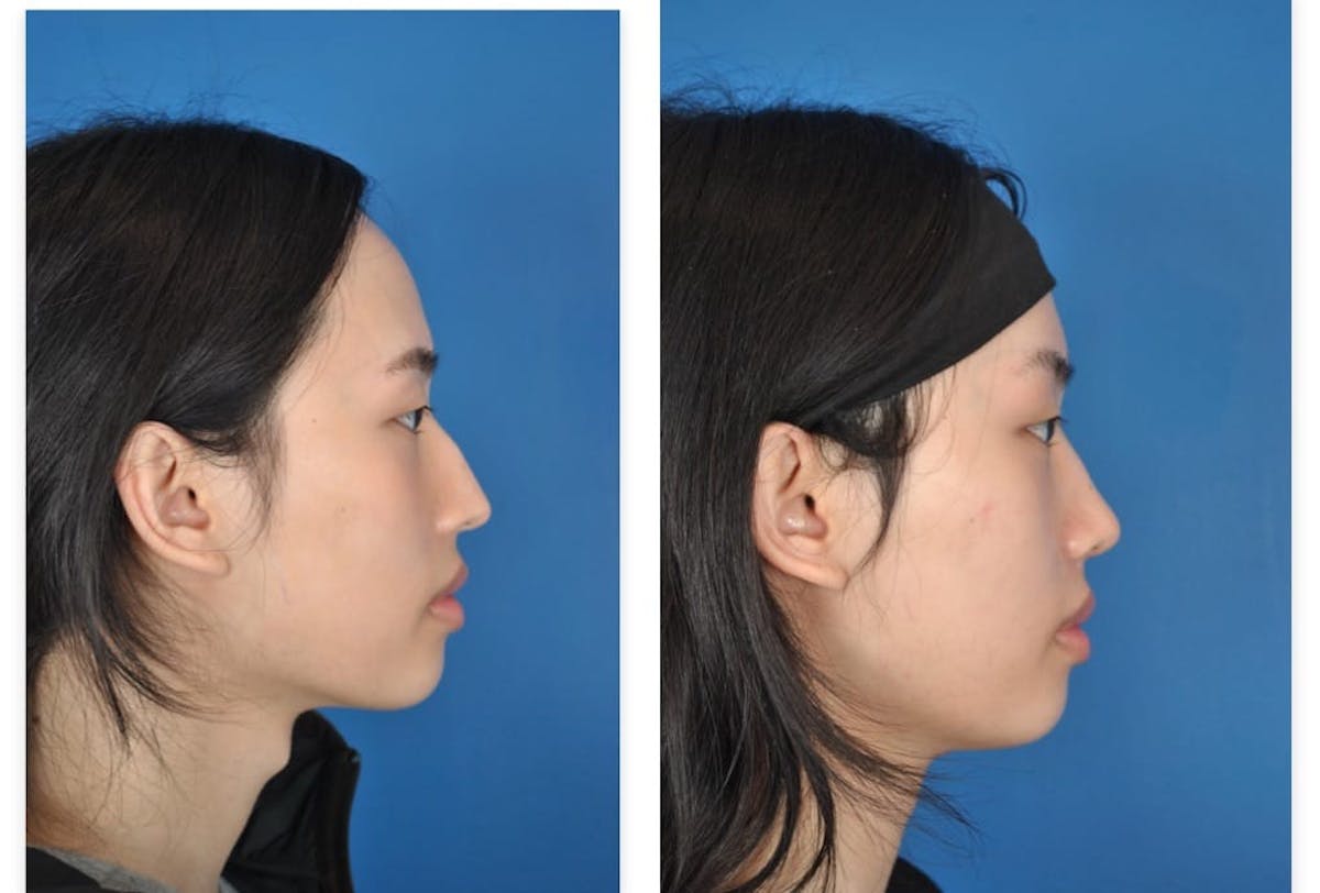Facial Feminization Before & After Gallery - Patient 179747965 - Image 2