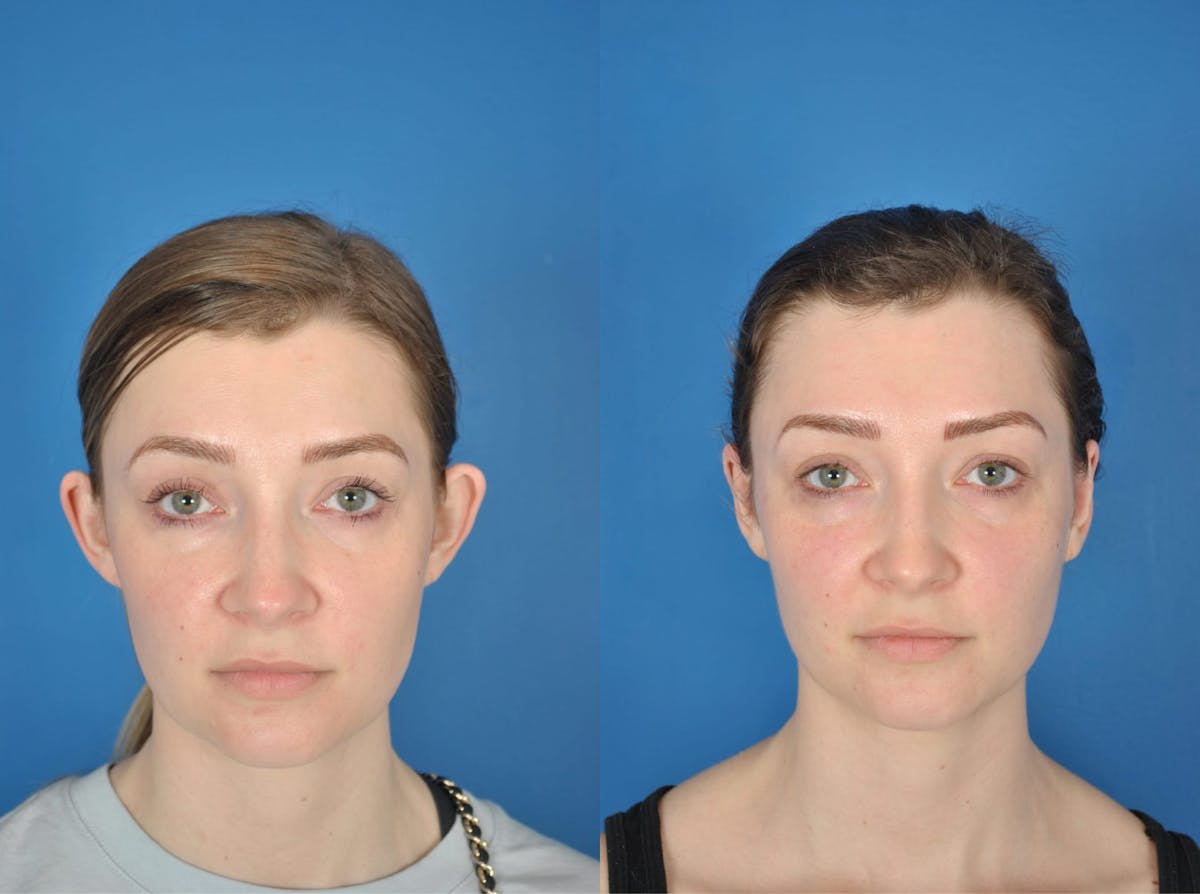 Otoplasty Before & After Gallery - Patient 179747656 - Image 1