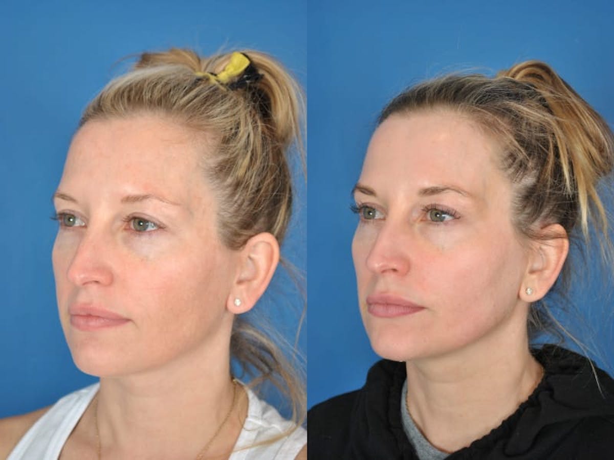 Laser Skin Resurfacing Before & After Gallery - Patient 177571154 - Image 2