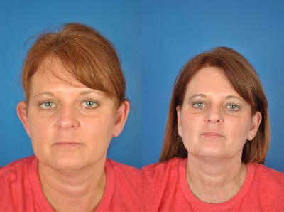 Otoplasty Before & After Gallery - Patient 179748253 - Image 1