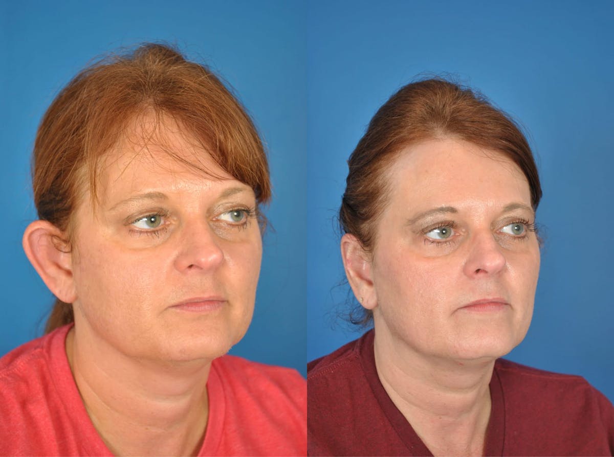 Otoplasty Before & After Gallery - Patient 179748253 - Image 2
