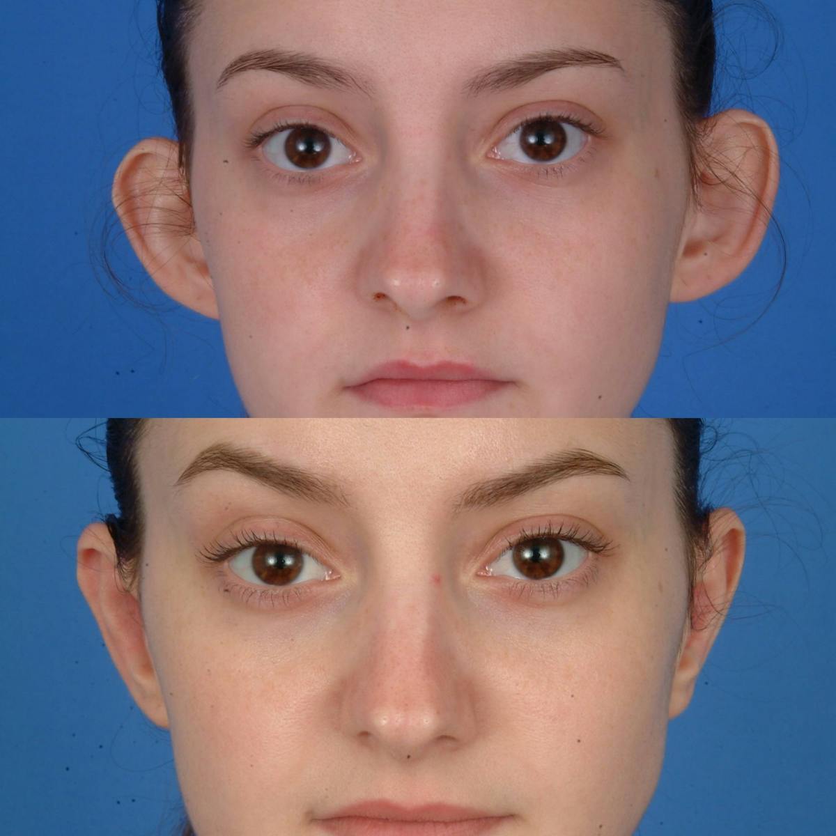 Otoplasty Before & After Gallery - Patient 179748257 - Image 1