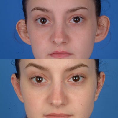 Otoplasty Before & After Gallery - Patient 179748257 - Image 1
