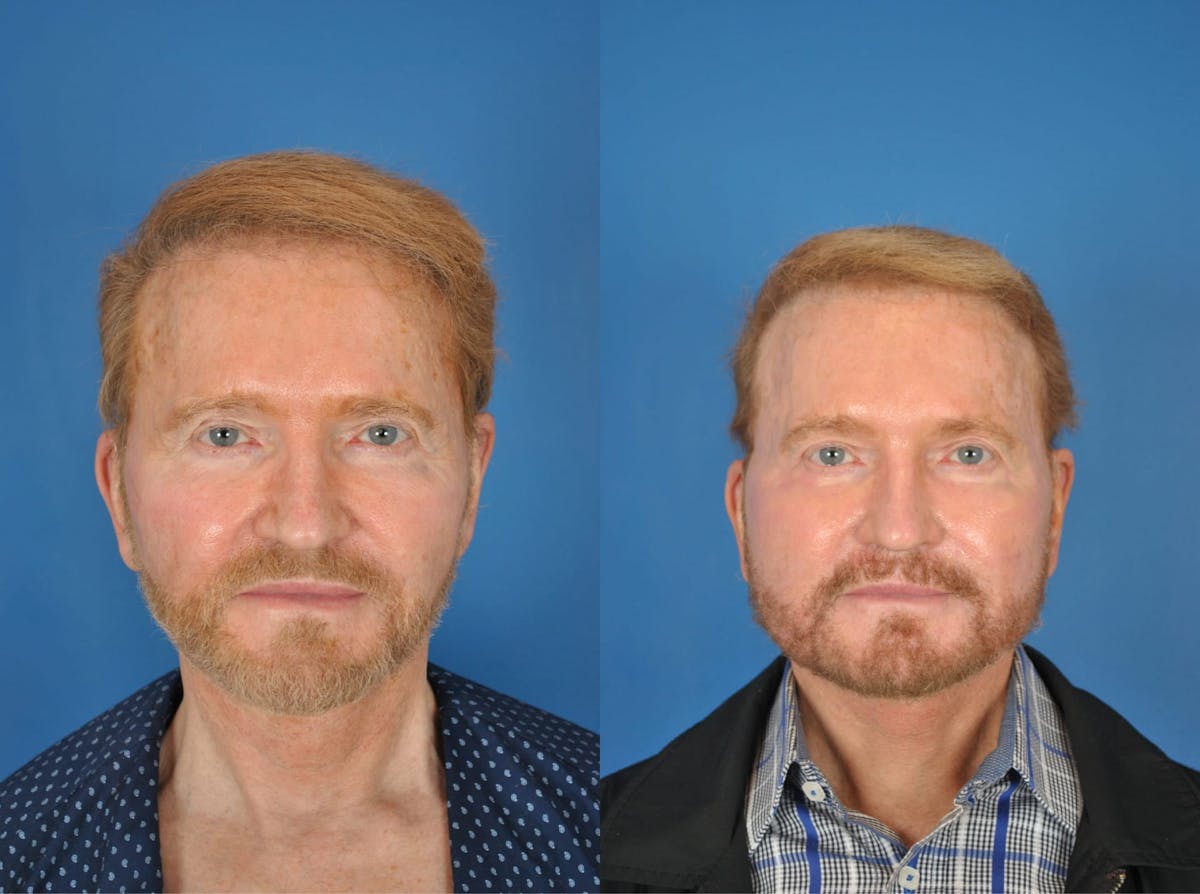 Facelifts Before & After Gallery - Patient 179748898 - Image 1