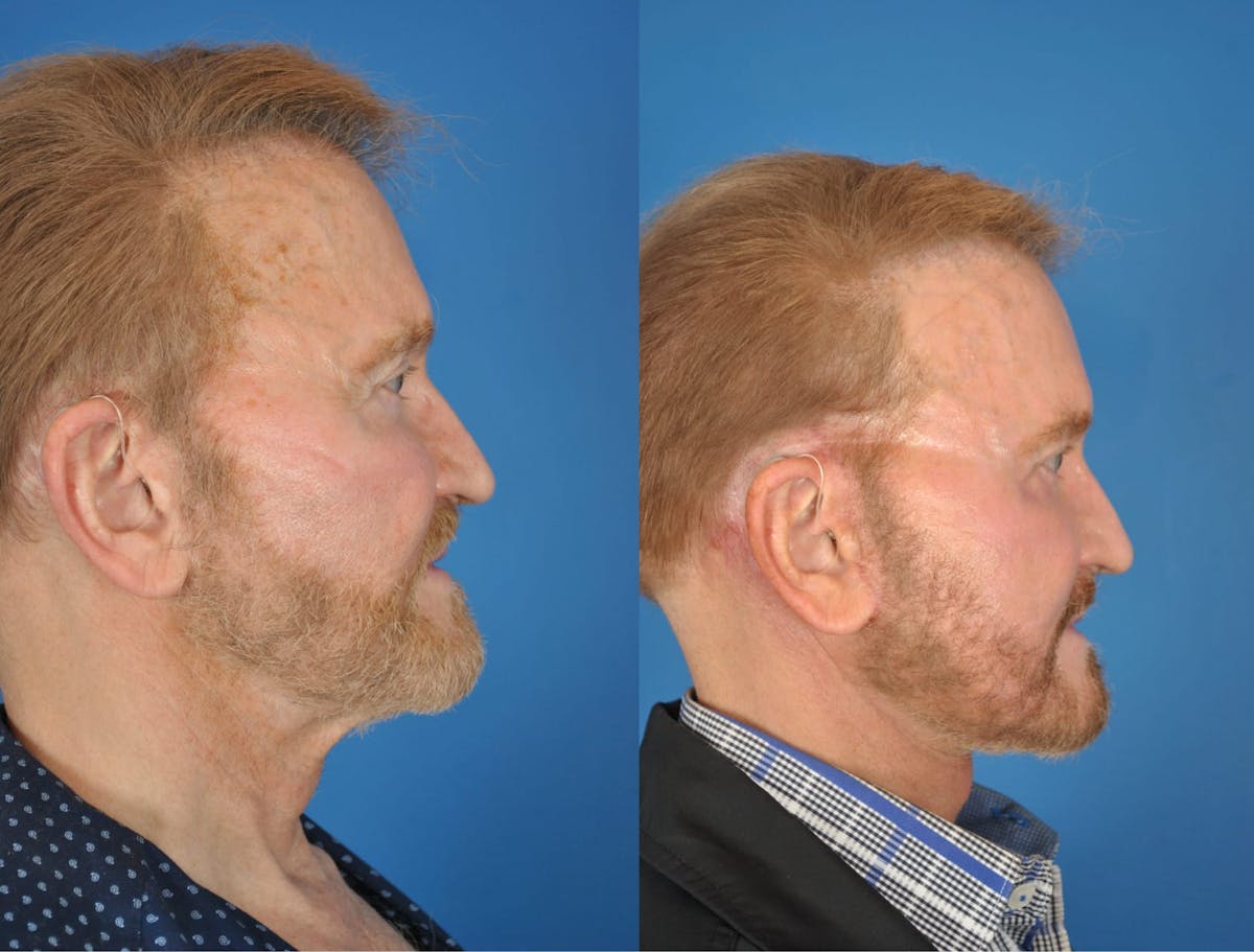 Mandibular Angle Augmentation Before & After Gallery - Patient 179748896 - Image 2