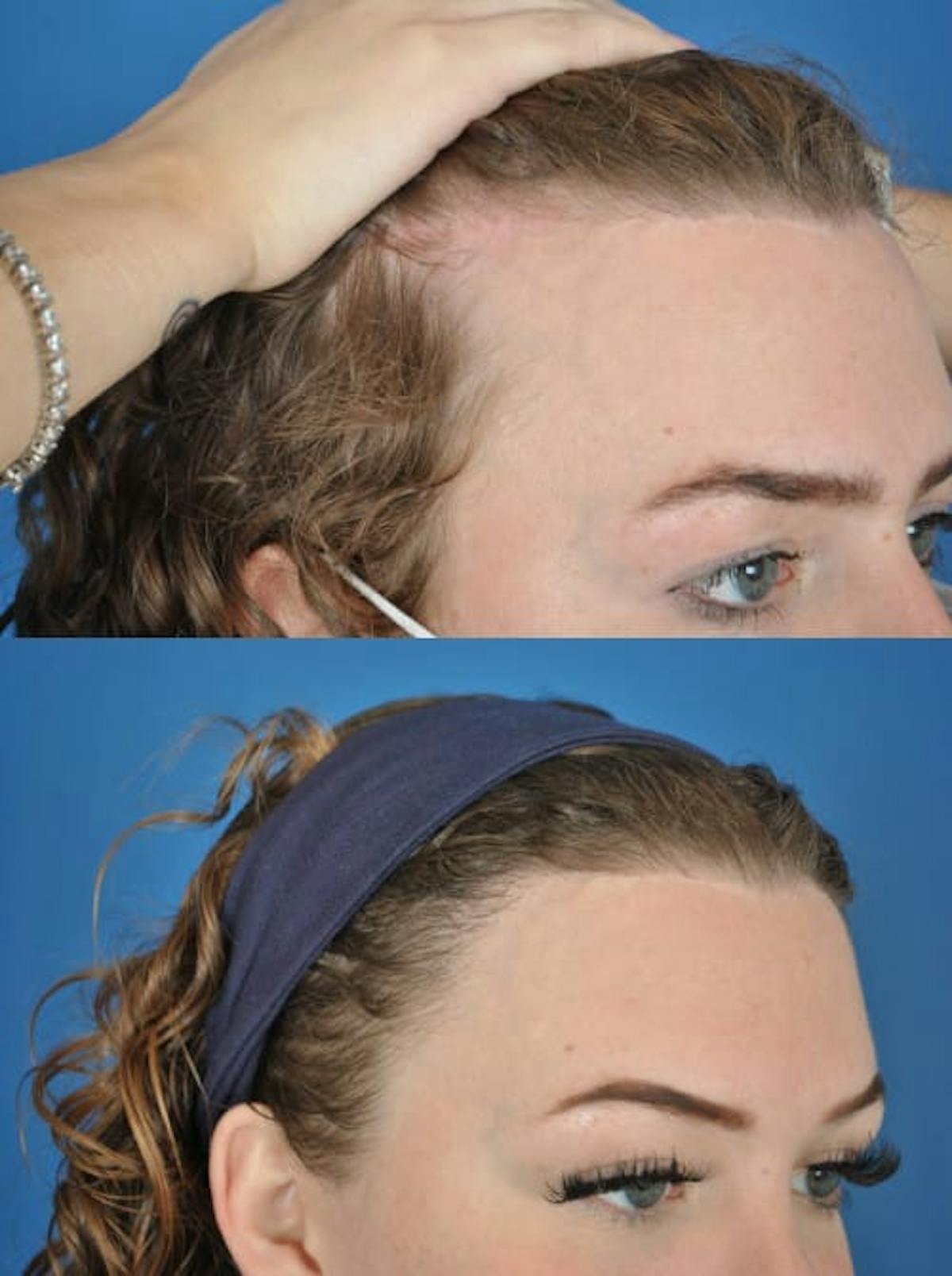 Hair Restoration Before & After Gallery - Patient 179748897 - Image 1