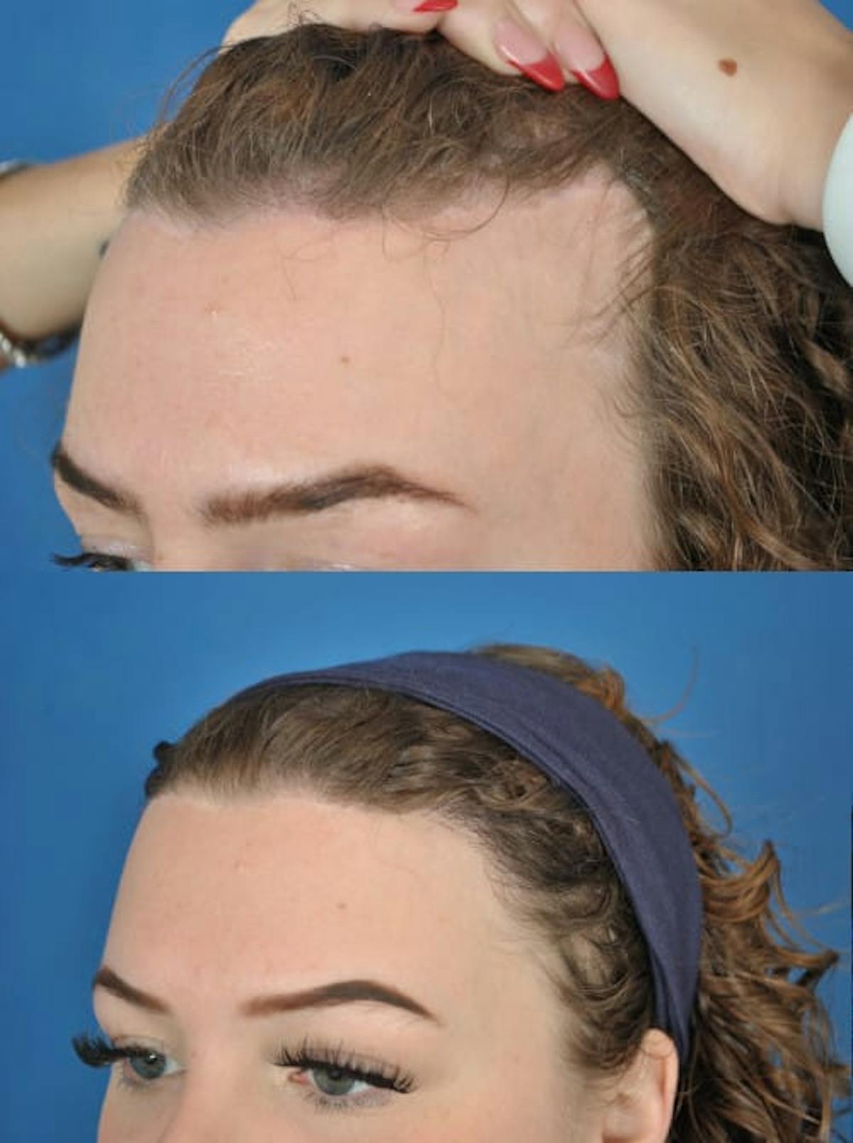 Hair Restoration Before & After Gallery - Patient 179748897 - Image 2