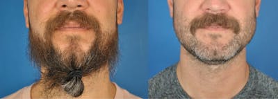 Mandibular Angle Augmentation Before & After Gallery - Patient 179748964 - Image 1