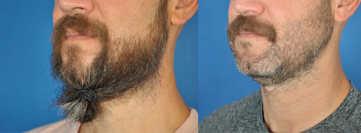 Mandibular Angle Augmentation Before & After Gallery - Patient 179748964 - Image 3