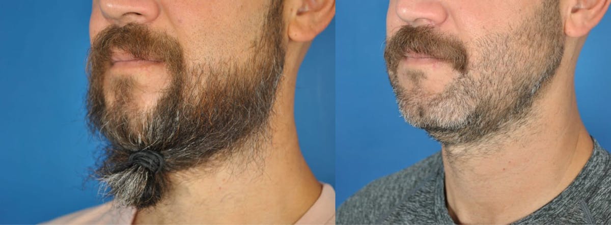 Mandibular Angle Augmentation Before & After Gallery - Patient 179748964 - Image 3