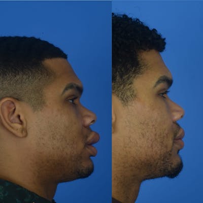 Lip Reduction Before & After Gallery - Patient 179749541 - Image 1