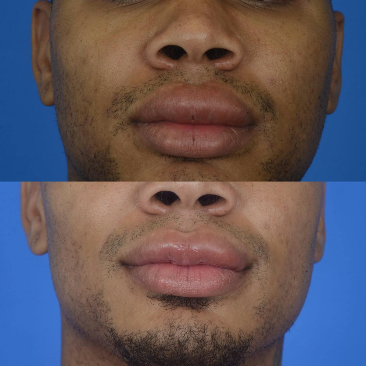 Lip Reduction Before & After Gallery - Patient 179749541 - Image 2
