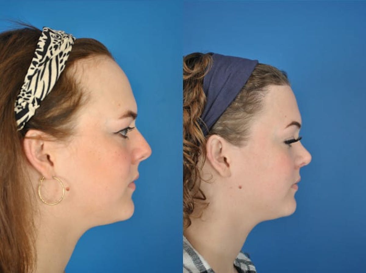 Hairline Advancement Before & After Gallery - Patient 180186338 - Image 6