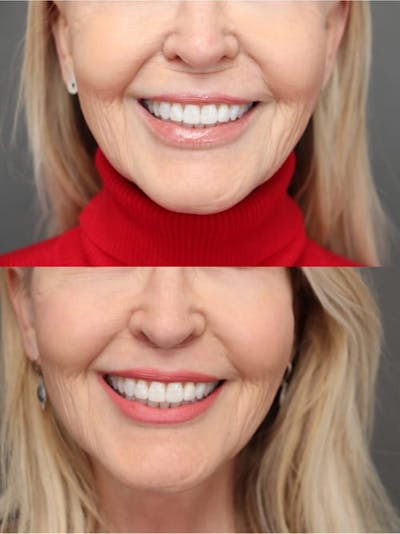 Lip Lifts Before & After Gallery - Patient 179508995 - Image 1