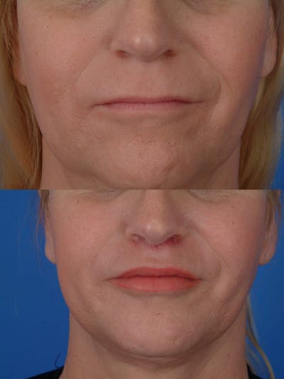 Lip Lifts Before & After Gallery - Patient 177570552 - Image 1