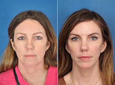 Facelifts Before & After Gallery - Patient 179737256 - Image 1