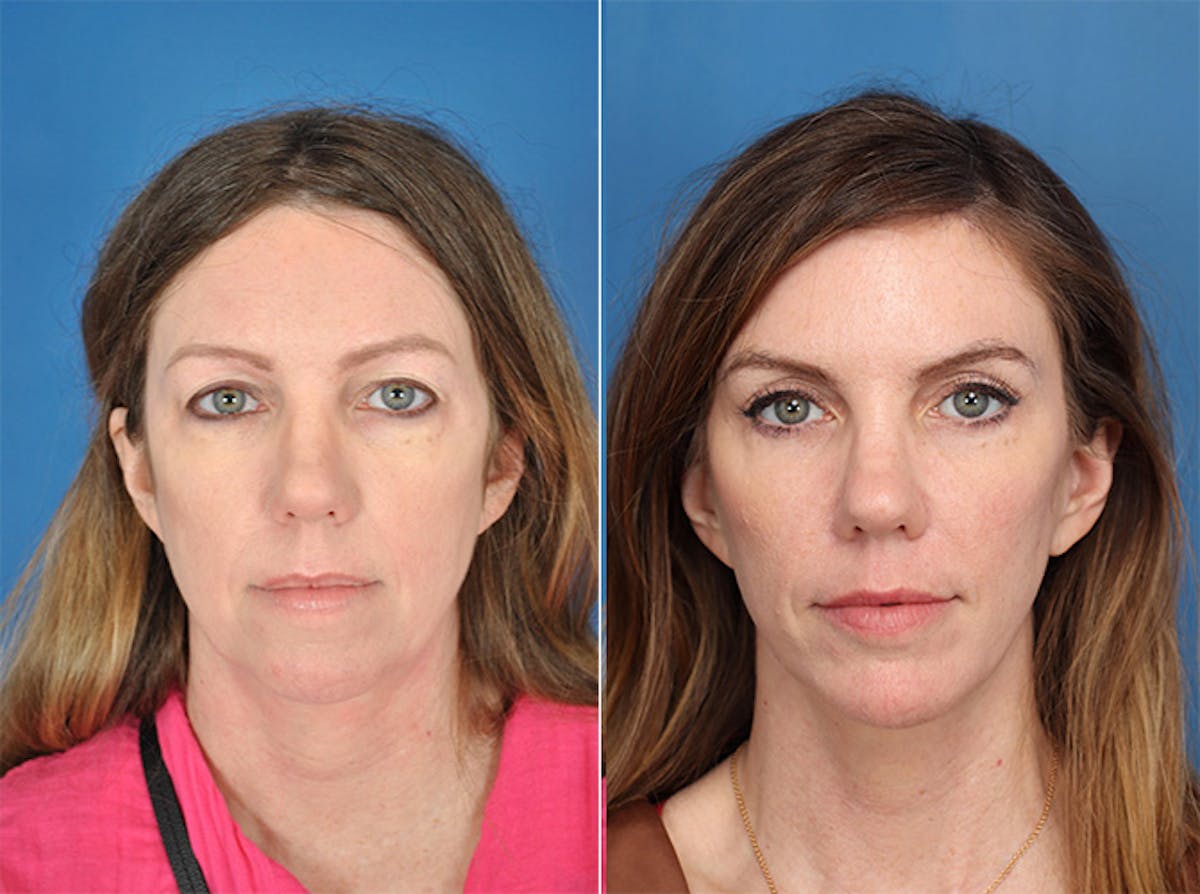 Facelifts Before & After Gallery - Patient 177570588 - Image 2