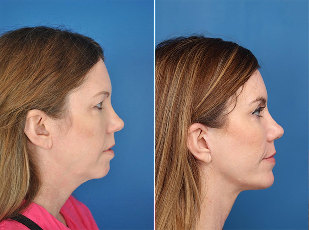 Facelifts Before & After Gallery - Patient 177570588 - Image 1