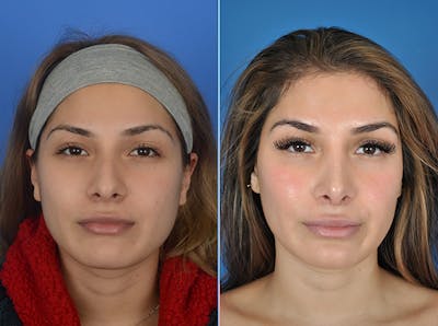 Rhinoplasty Before & After Gallery - Patient 177570520 - Image 1
