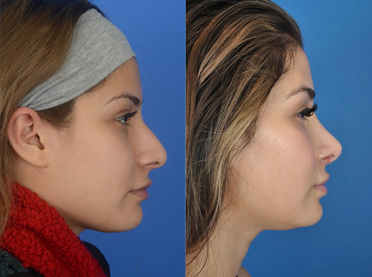 Rhinoplasty Before & After Gallery - Patient 177570520 - Image 2