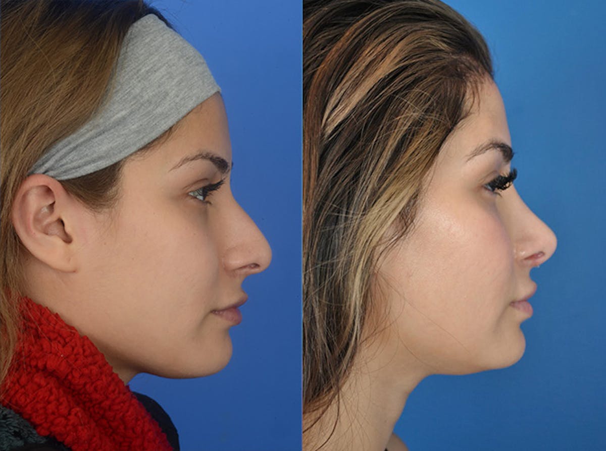 Rhinoplasty Before & After Gallery - Patient 177570520 - Image 1