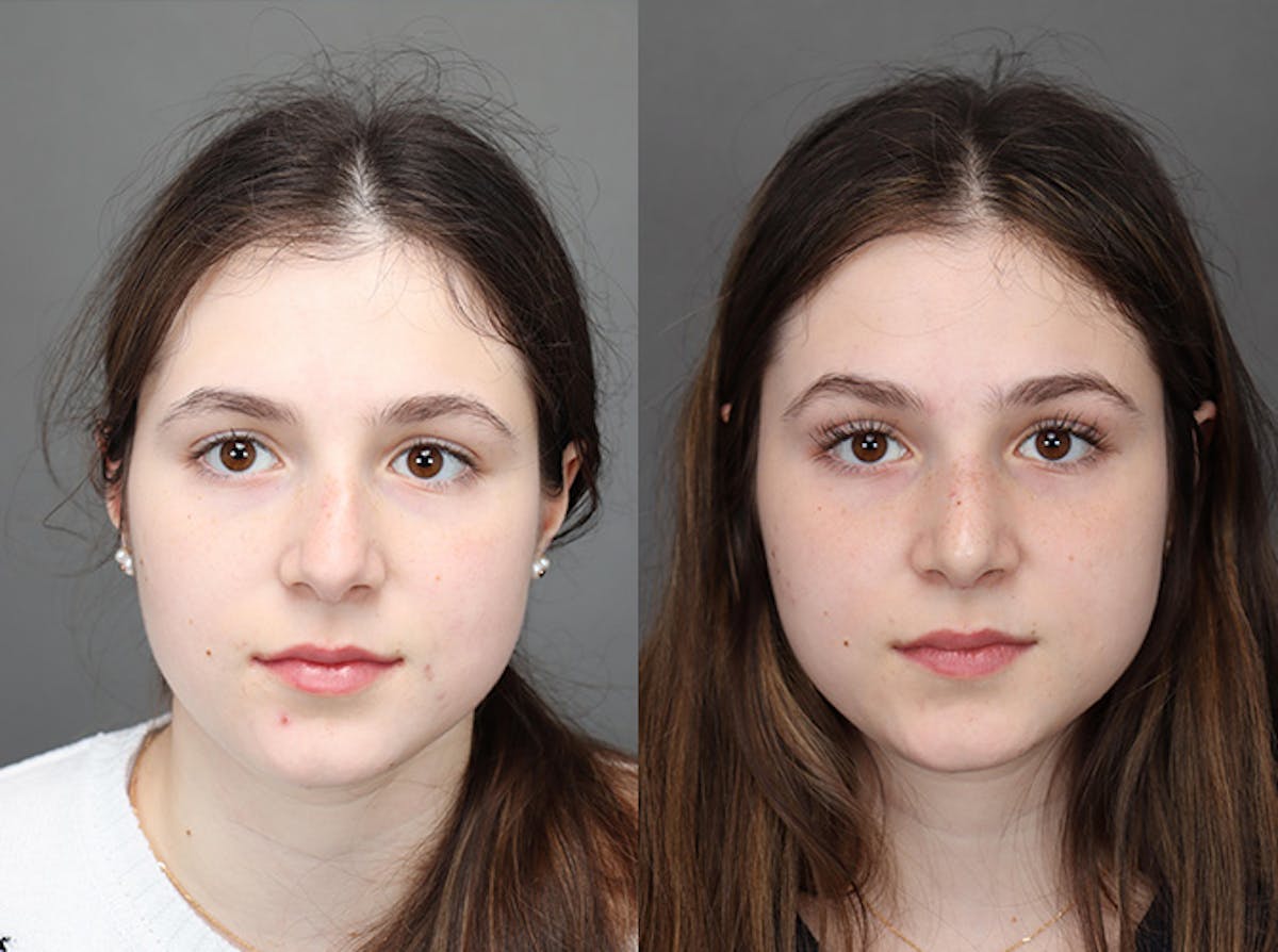 Rhinoplasty Before & After Gallery - Patient 179382051 - Image 2