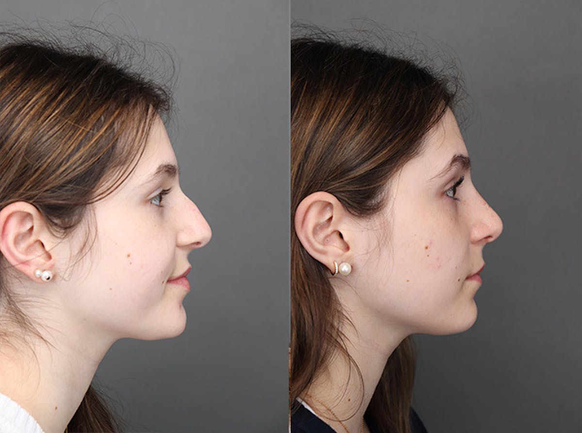 Rhinoplasty Before & After Gallery - Patient 179382051 - Image 1