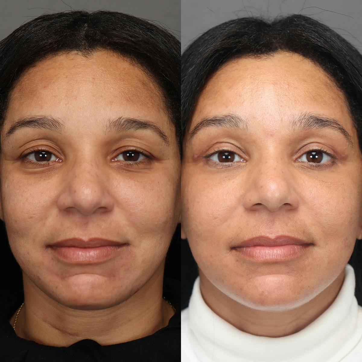 Eyelifts & Blepharoplasty Before & After Gallery - Patient 795049 - Image 1