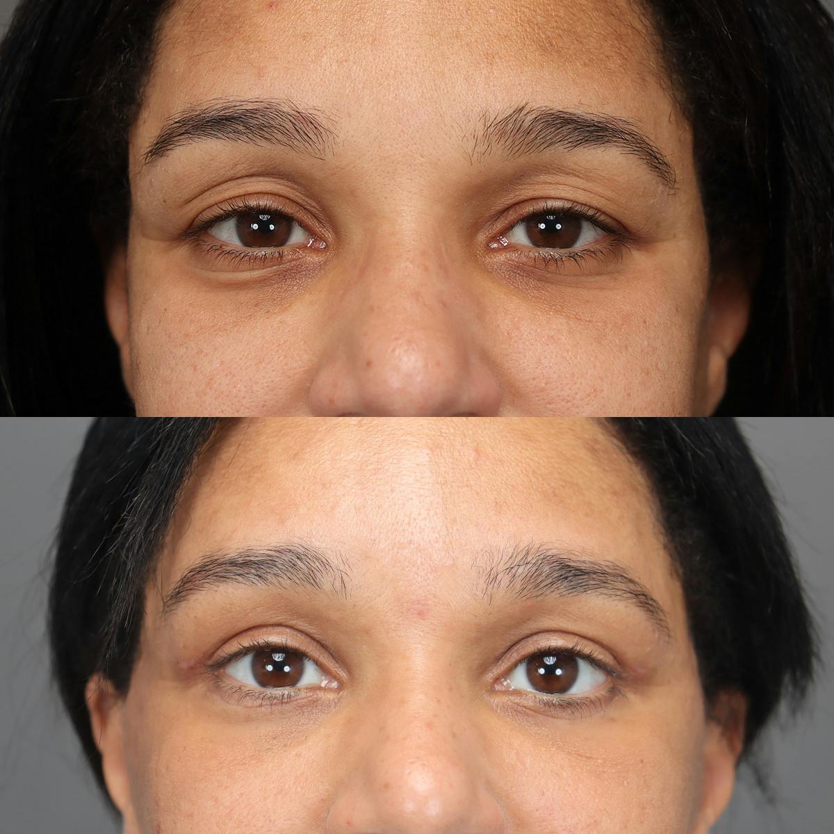 Eyelifts & Blepharoplasty Before & After Gallery - Patient 795049 - Image 2