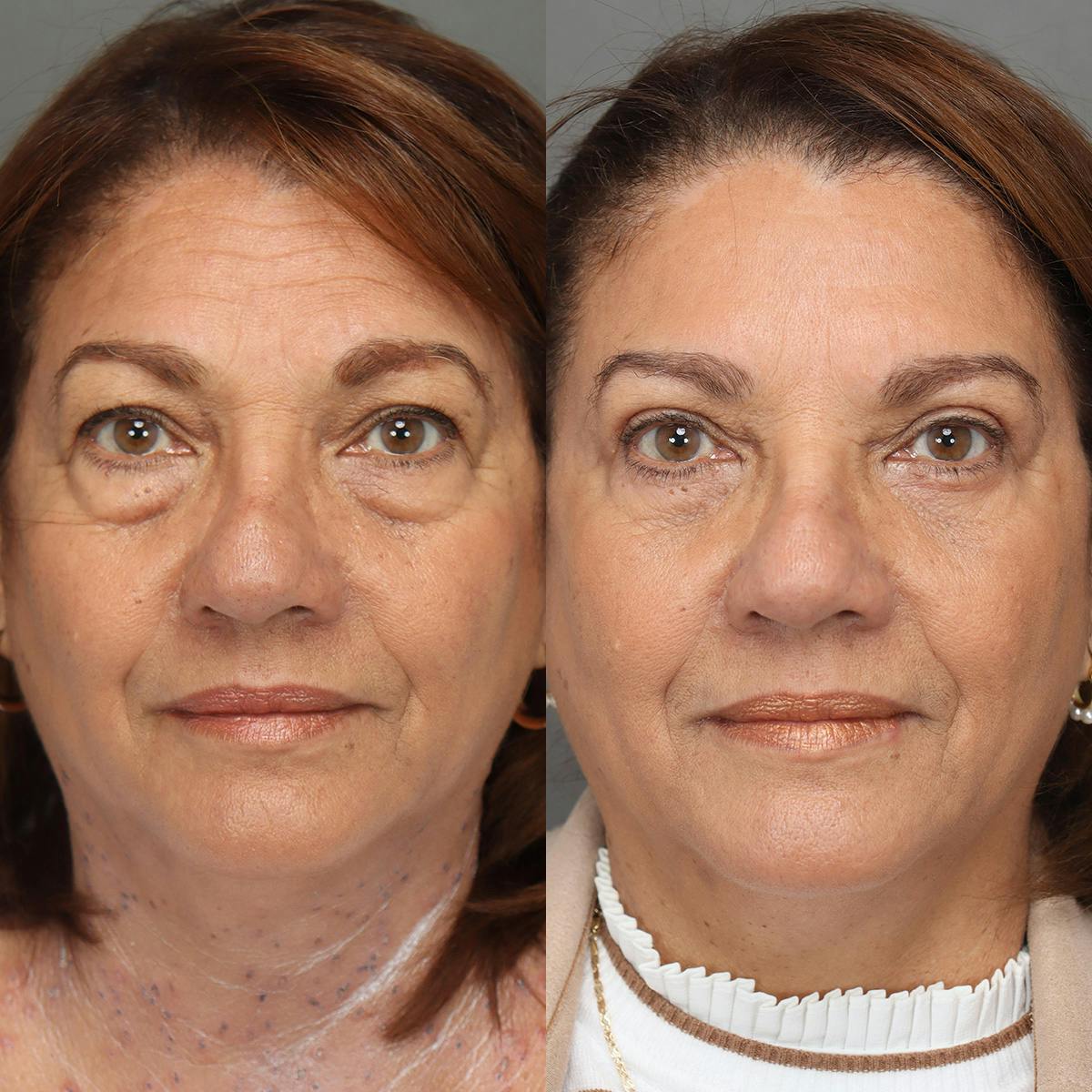 Eyelifts & Blepharoplasty Before & After Gallery - Patient 118215 - Image 1