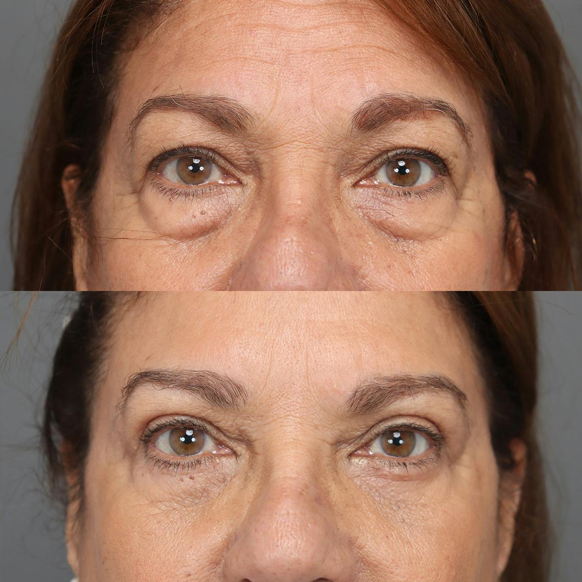 Eyelifts & Blepharoplasty Before & After Gallery - Patient 118215 - Image 2