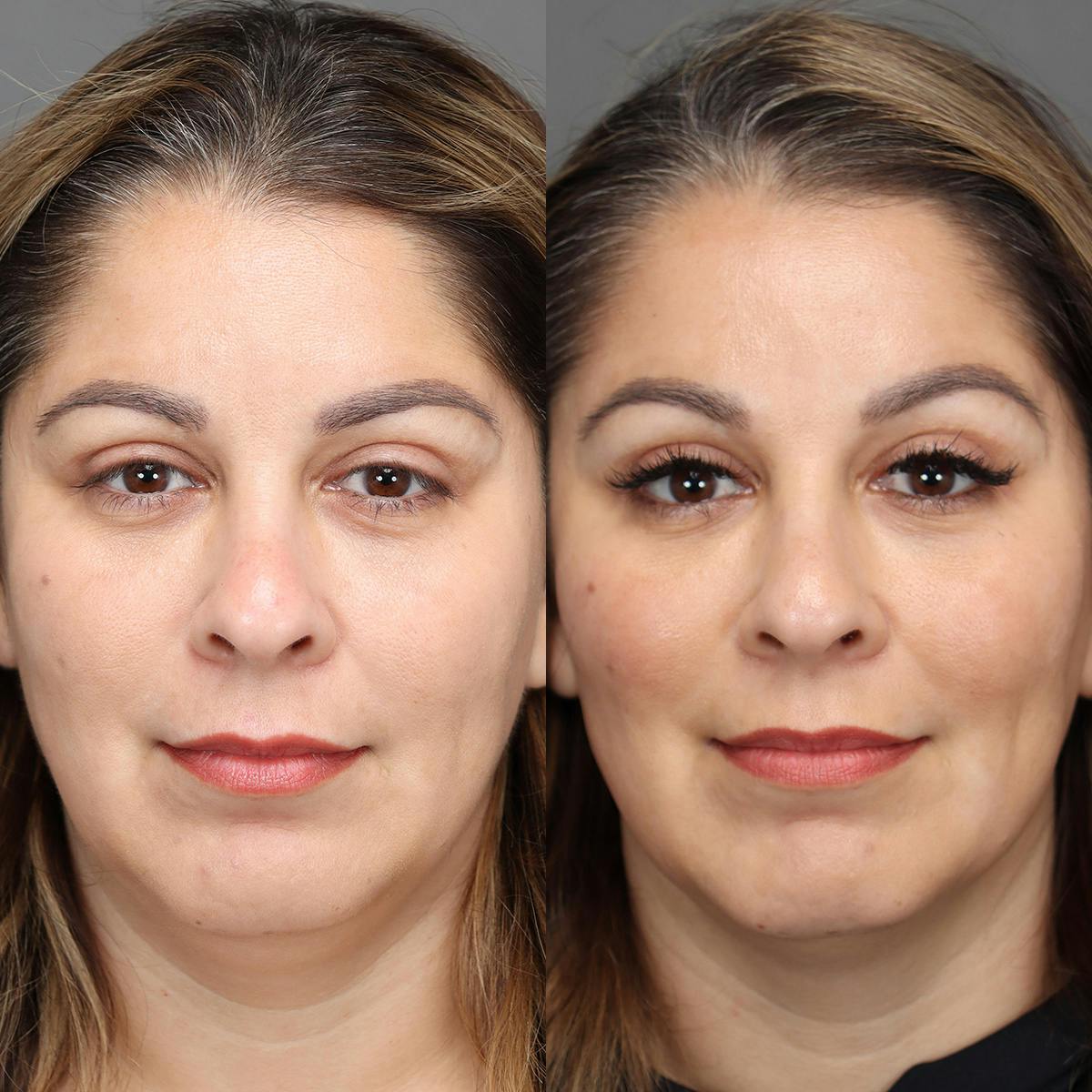 Brow Lifts Before & After Gallery - Patient 833684 - Image 1