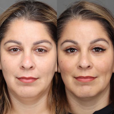 Brow Lifts Before & After Gallery - Patient 833684 - Image 1