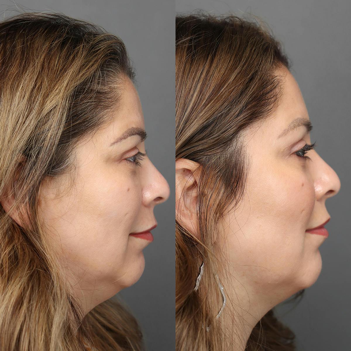 Brow Lifts Before & After Gallery - Patient 833684 - Image 2