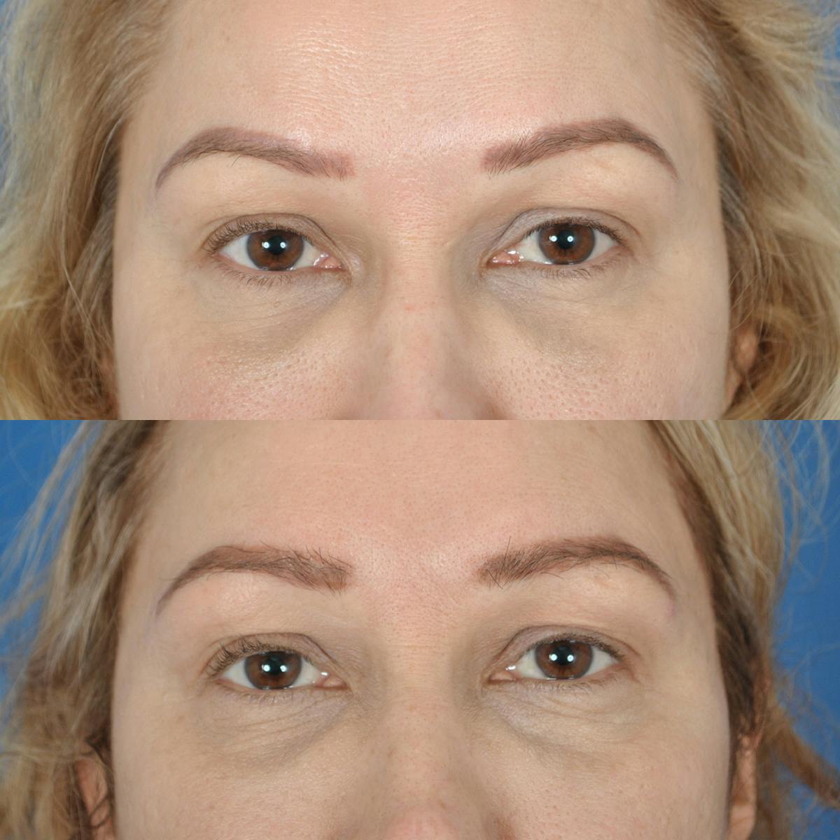 Eyebrow Transplant Before & After Gallery - Patient 467612 - Image 1