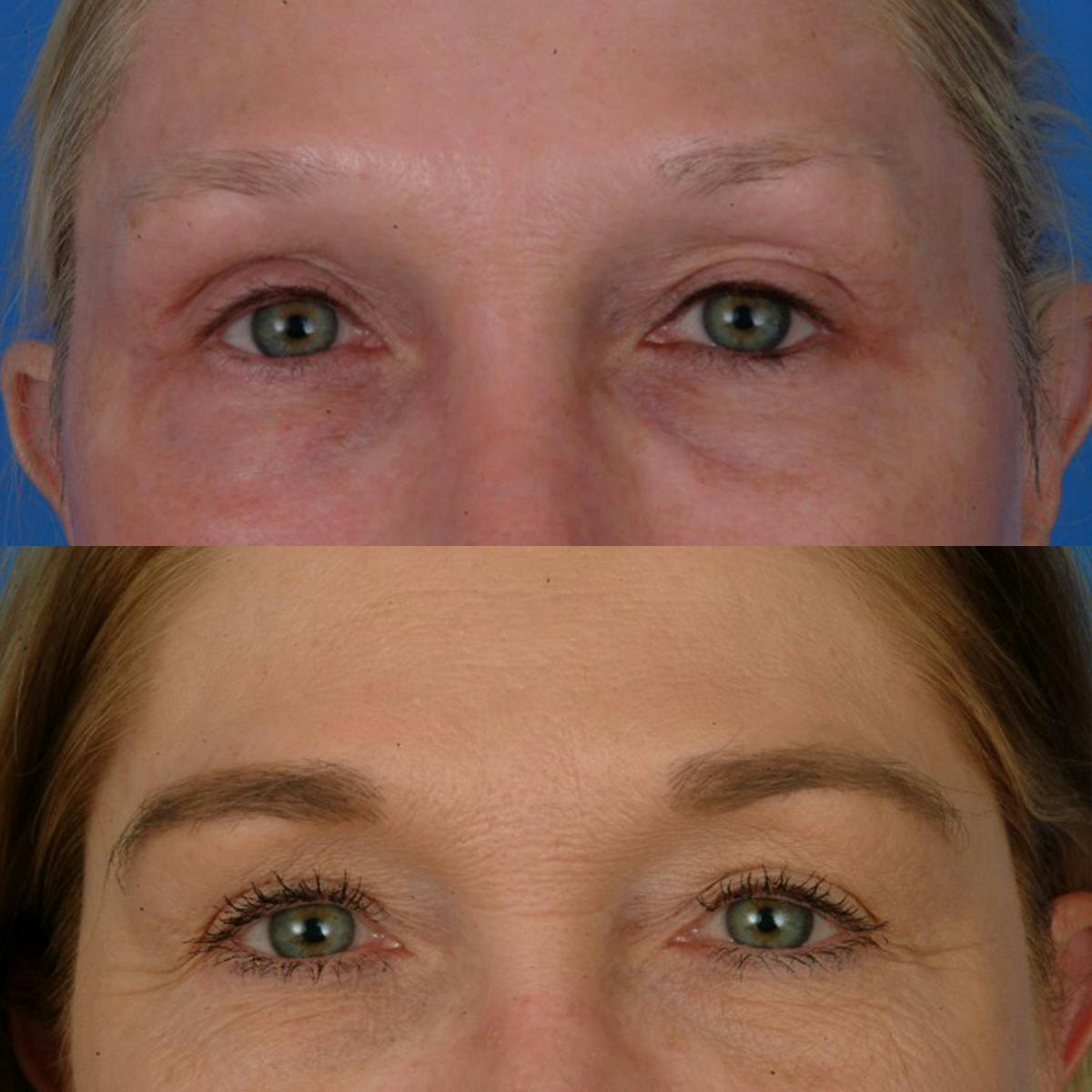 Eyebrow Transplant Before & After Gallery - Patient 206281 - Image 1