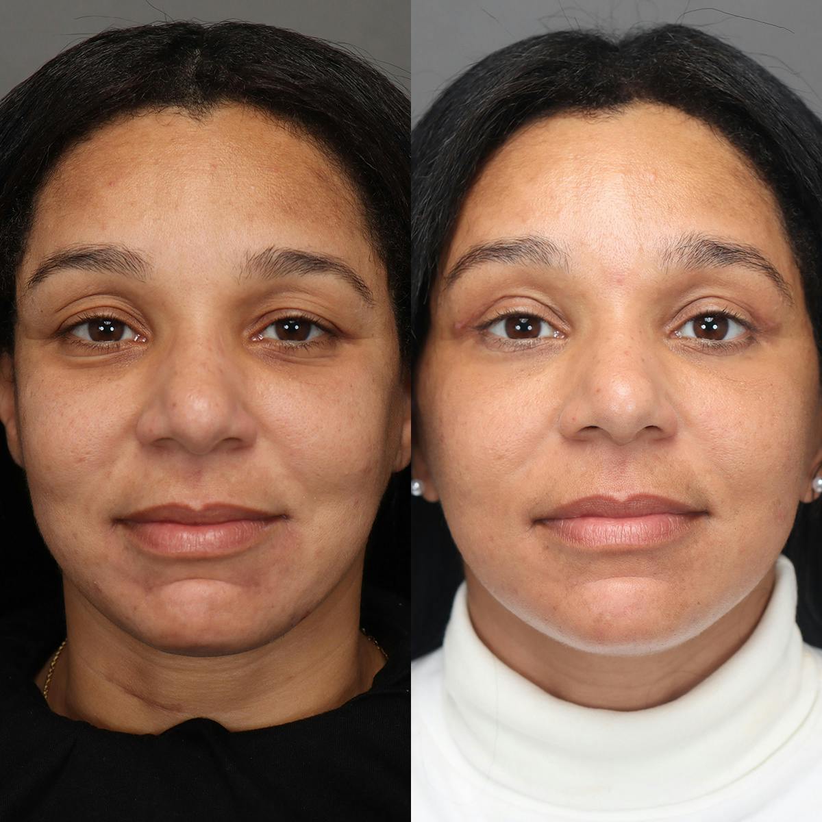 Facelifts Before & After Gallery - Patient 219744 - Image 1