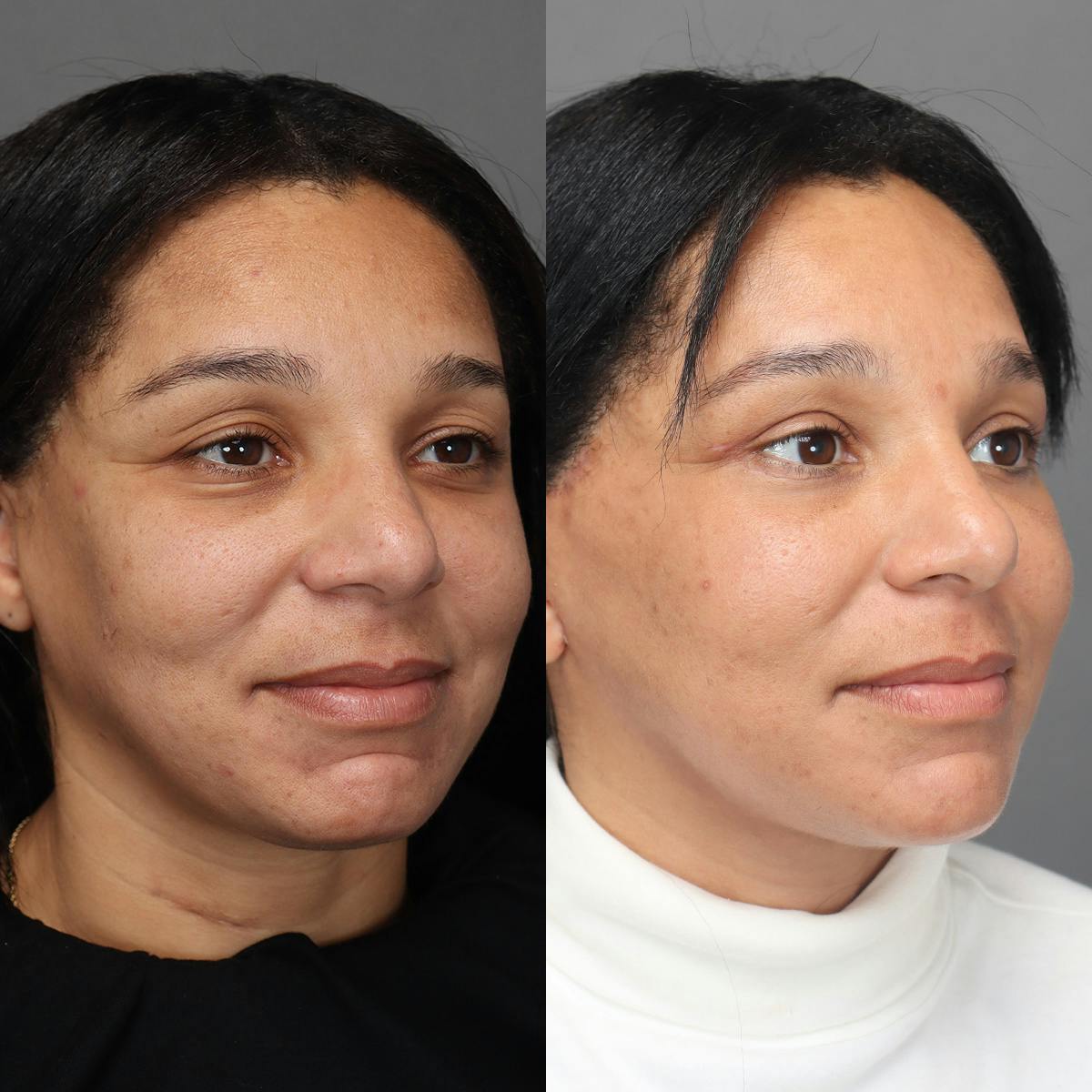 Facelifts Before & After Gallery - Patient 219744 - Image 2