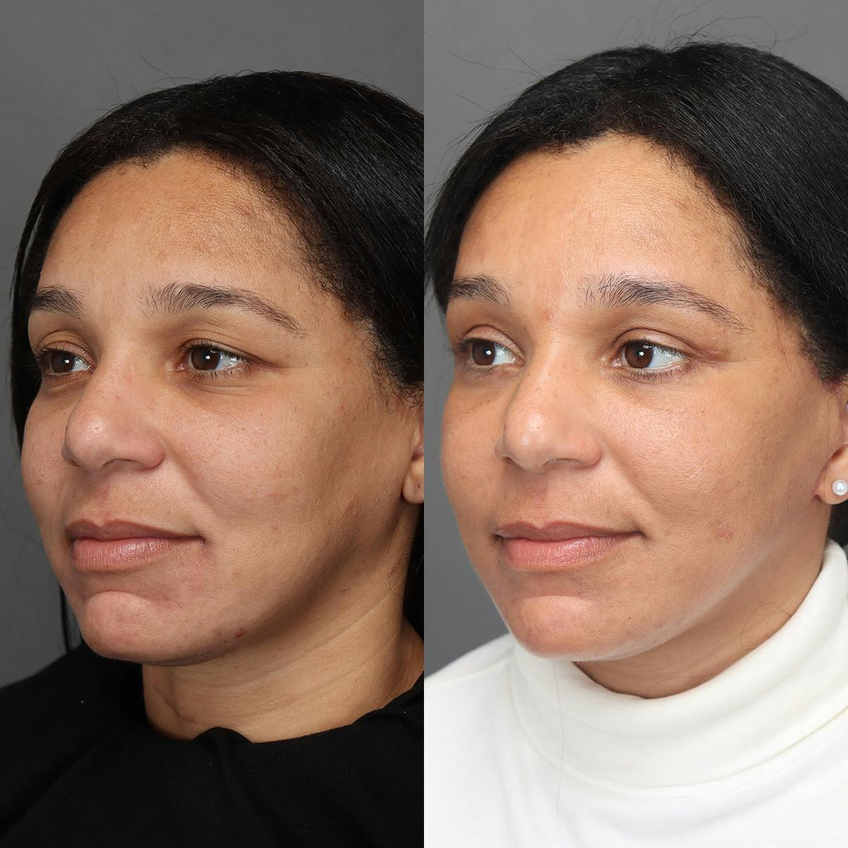 Facelifts Before & After Gallery - Patient 219744 - Image 3