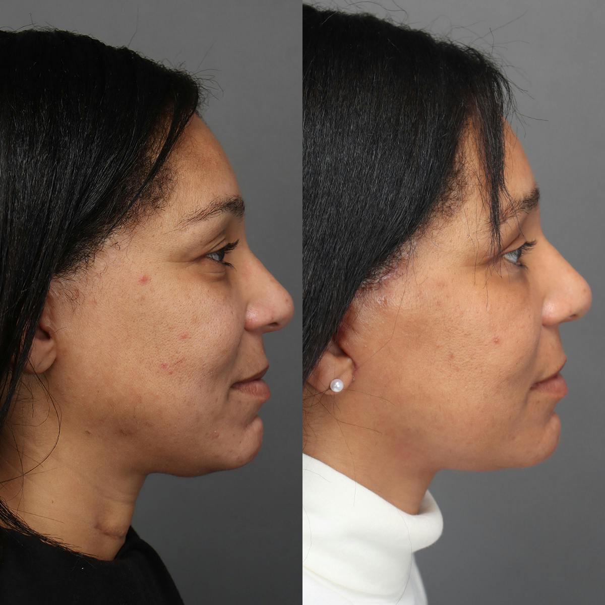 Facelifts Before & After Gallery - Patient 219744 - Image 4