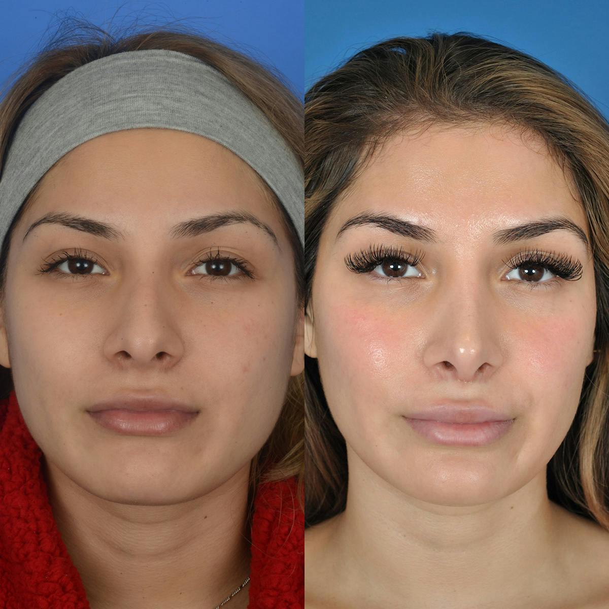 Rhinoplasty Before & After Gallery - Patient 198442 - Image 2