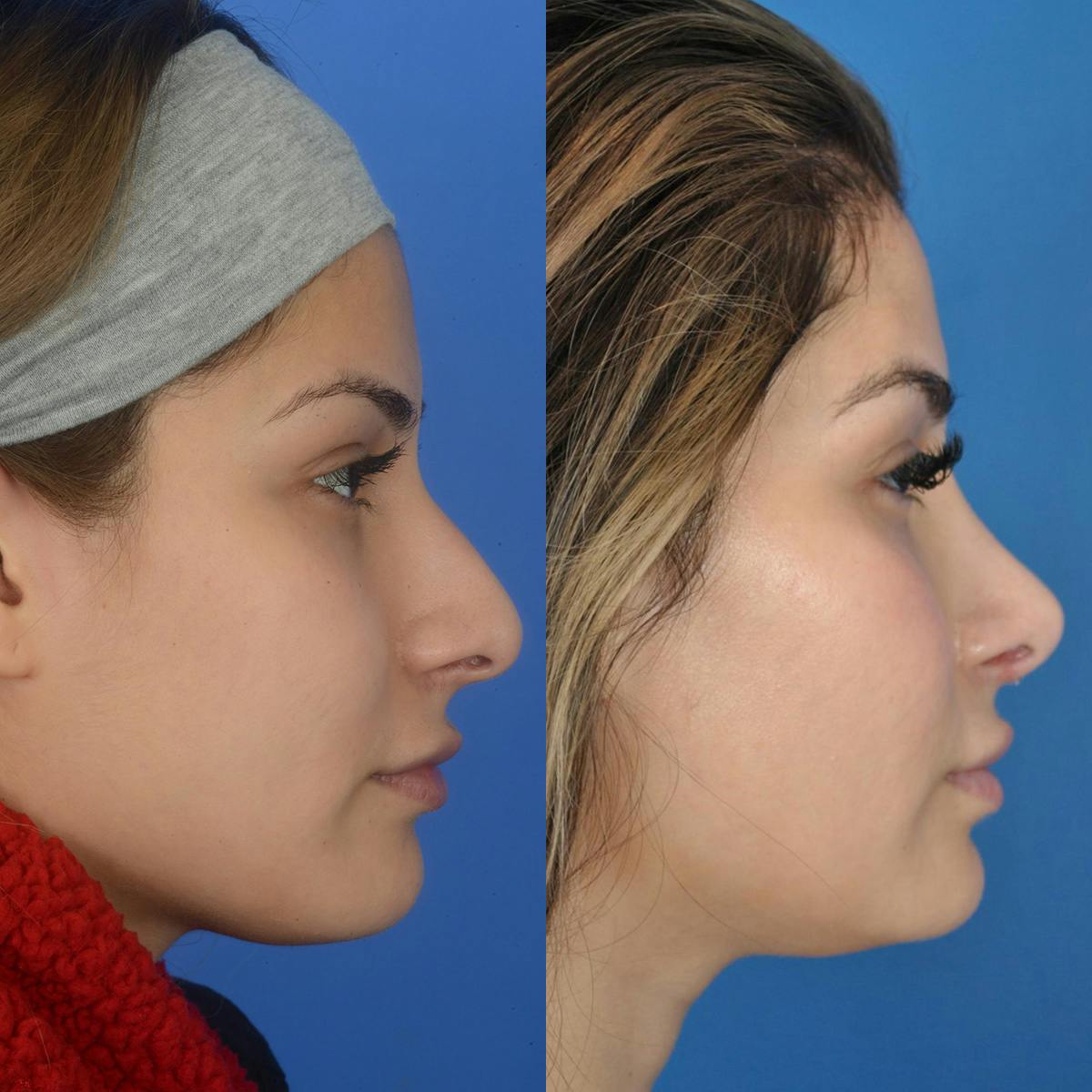 Rhinoplasty Before & After Gallery - Patient 198442 - Image 1