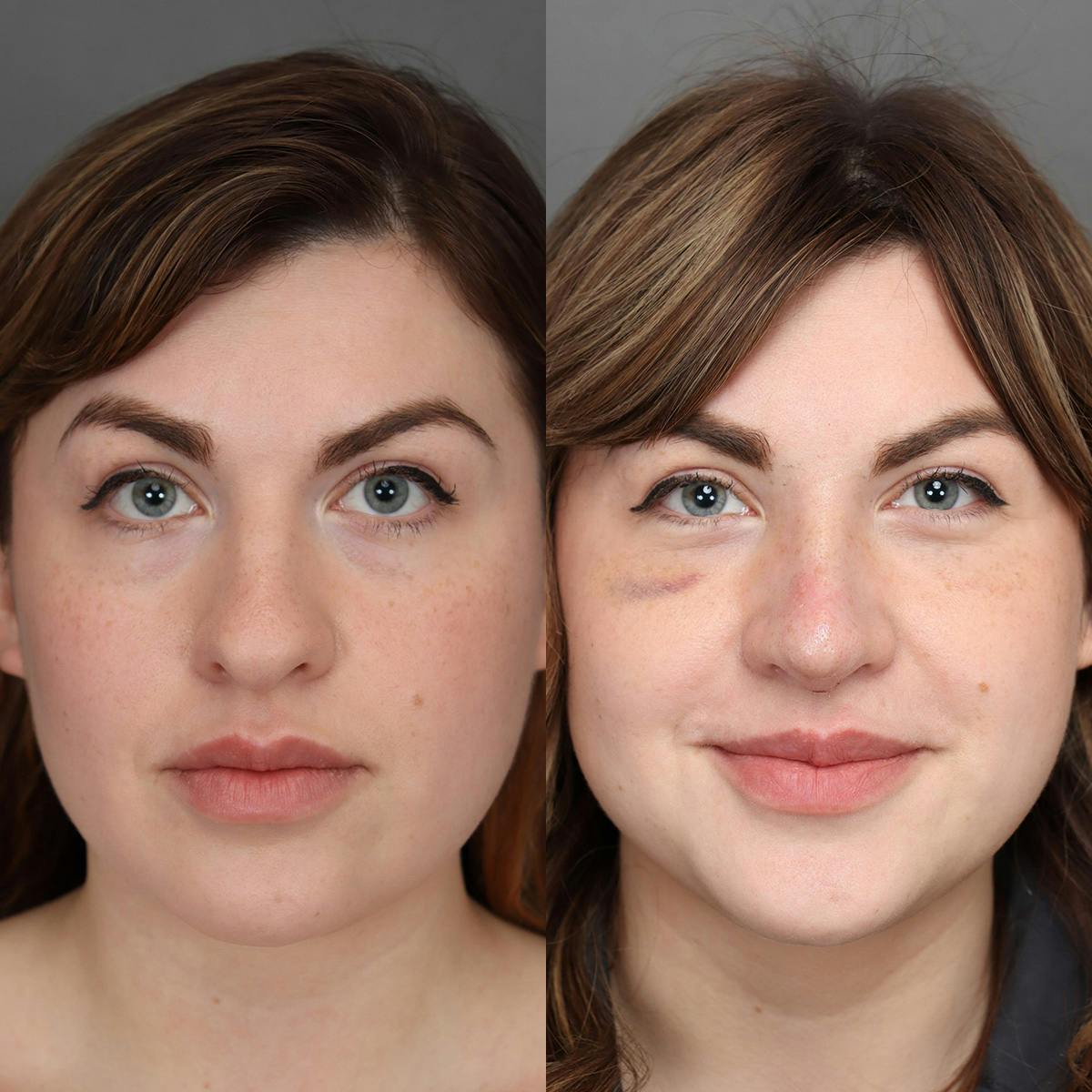 Rhinoplasty Before & After Gallery - Patient 200916 - Image 2