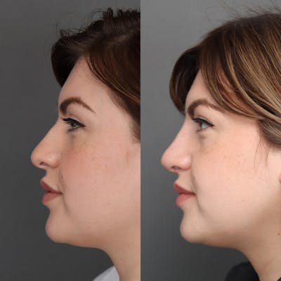 Rhinoplasty Before & After Gallery - Patient 200916 - Image 1