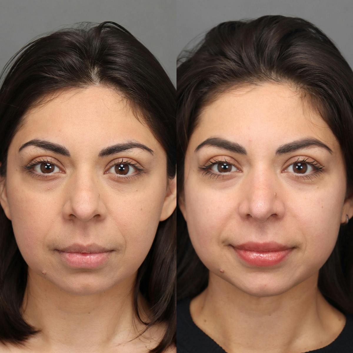 Rhinoplasty Before & After Gallery - Patient 176588 - Image 5