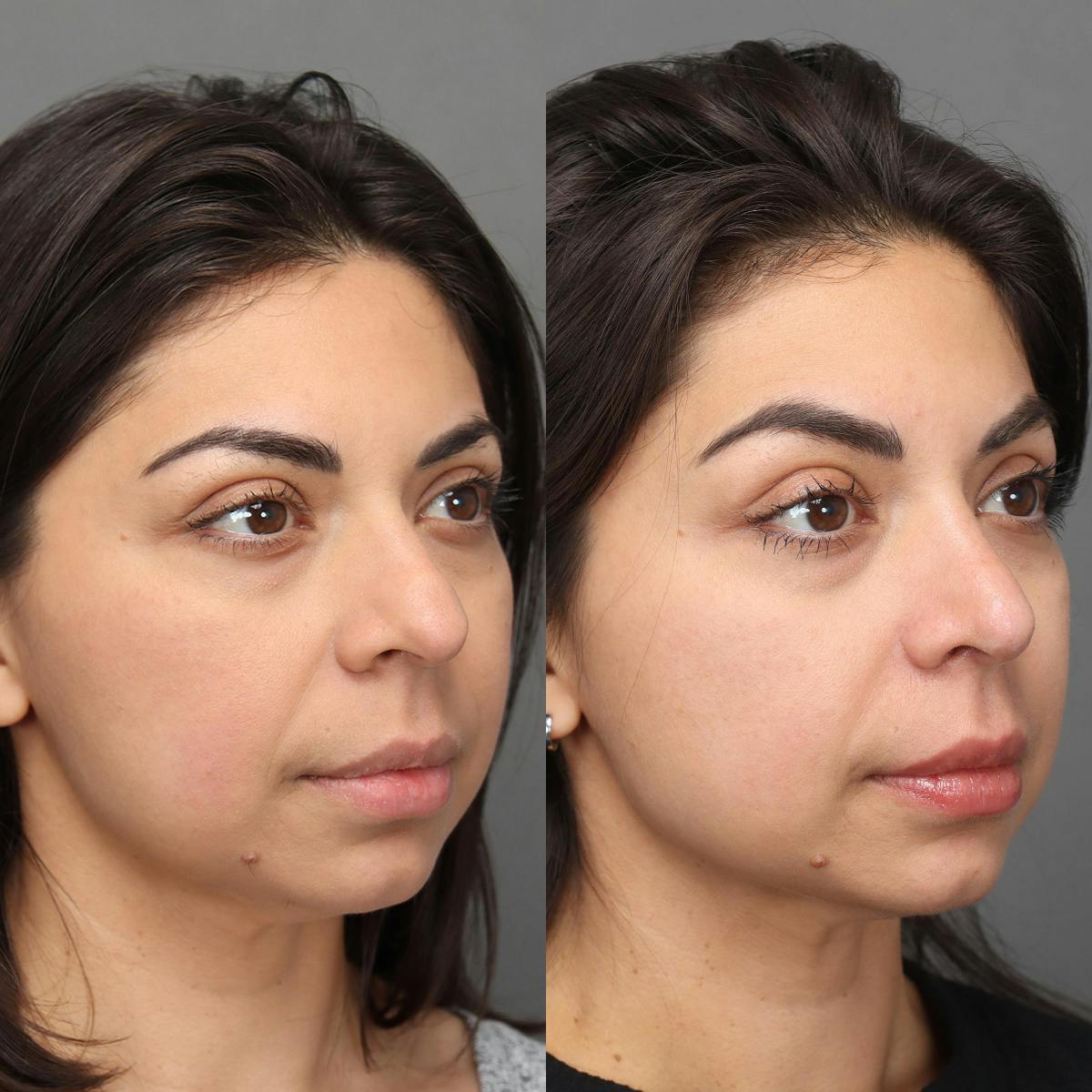 Rhinoplasty Before & After Gallery - Patient 176588 - Image 2