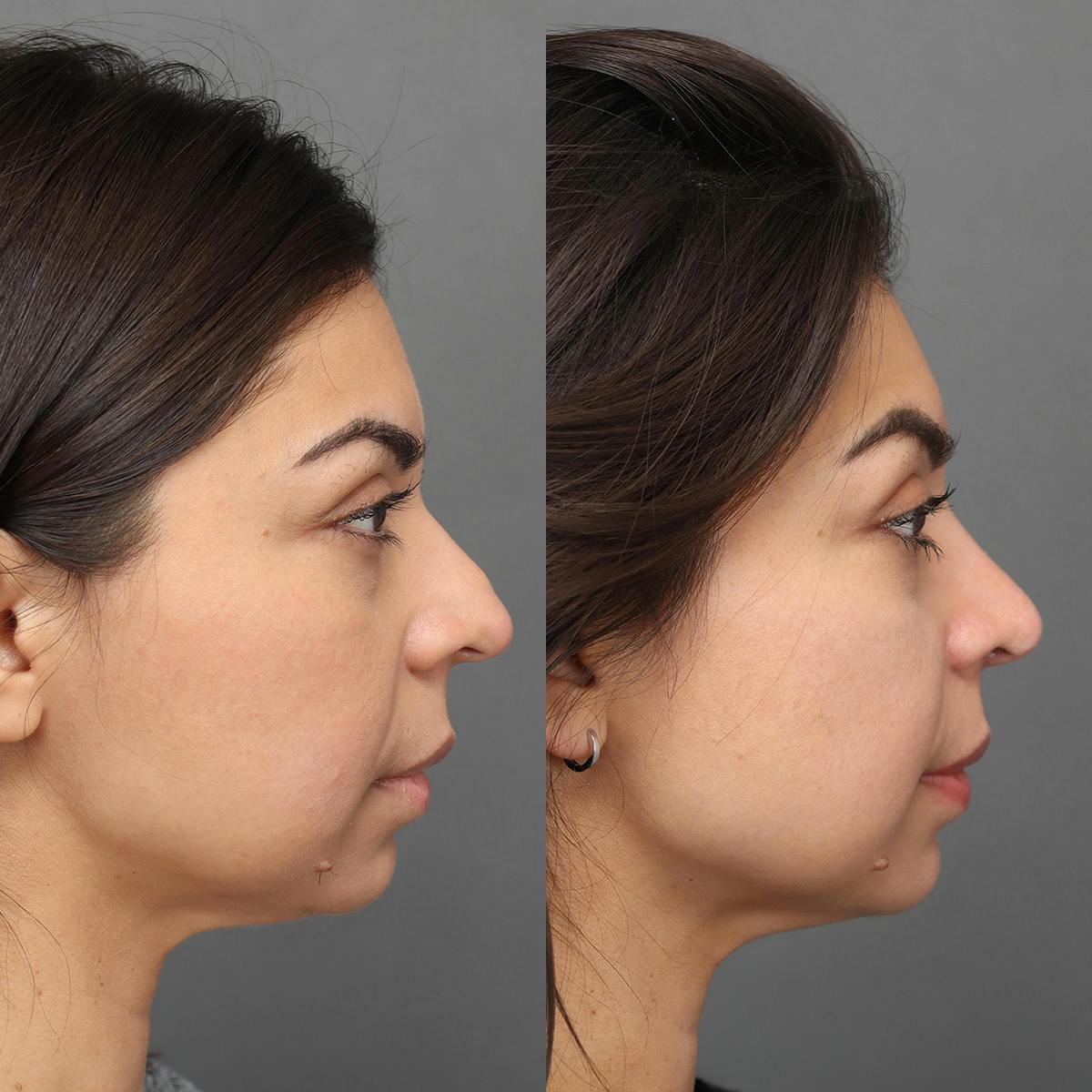 Rhinoplasty Before & After Gallery - Patient 176588 - Image 1