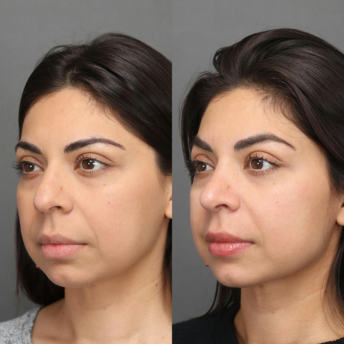 Rhinoplasty Before & After Gallery - Patient 176588 - Image 3