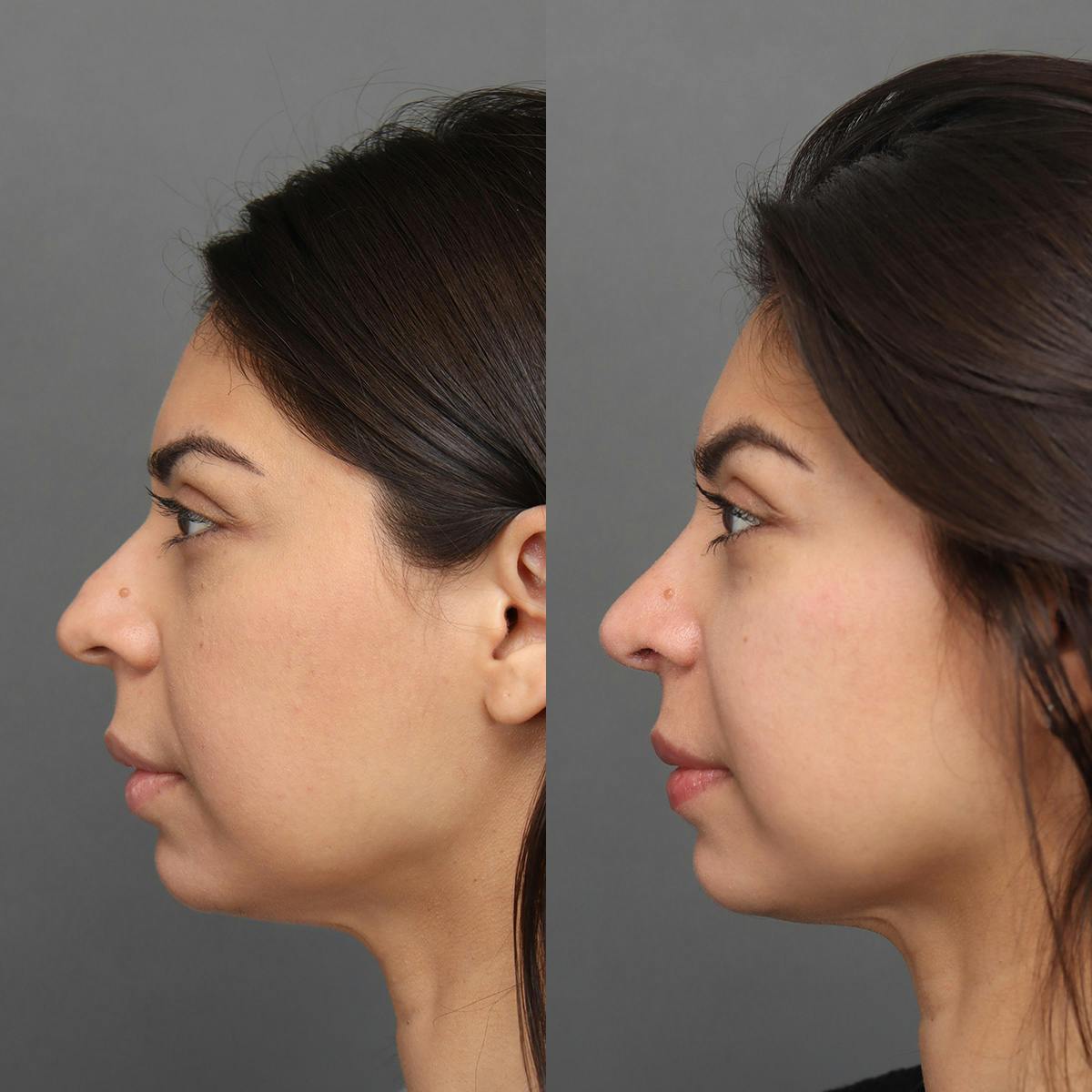 Rhinoplasty Before & After Gallery - Patient 176588 - Image 4