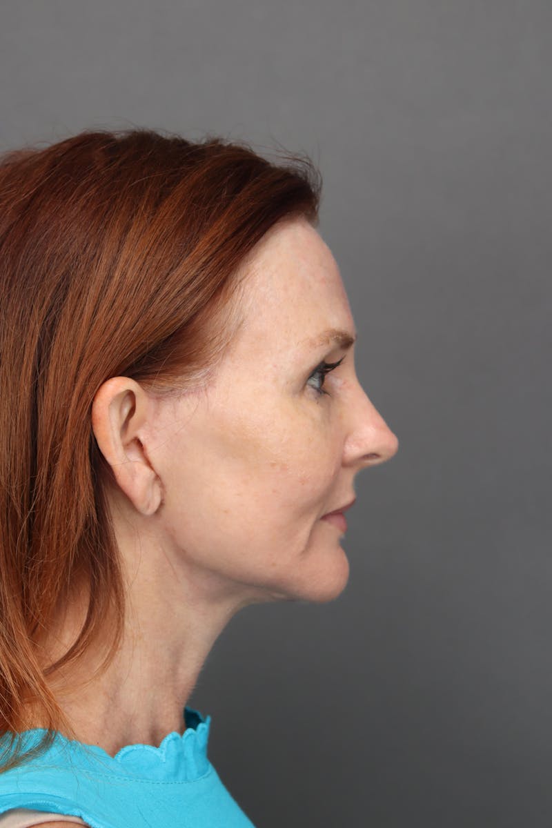 Weight Loss Facelift Before & After Gallery - Patient 251189 - Image 4